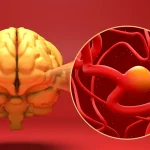 Anevrismul cerebral poate fi tratat fără operație clasică. Cum funcționează intervențiile minim invazive care reduc riscul de hemoragie