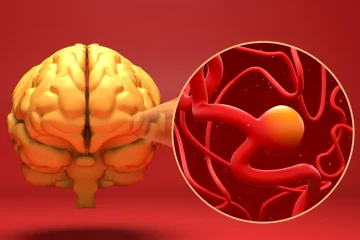 Anevrismul cerebral poate fi tratat fără operație clasică. Cum funcționează intervențiile minim invazive care reduc riscul de hemoragie
