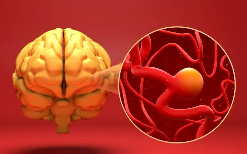 Anevrismul cerebral poate fi tratat fără operație clasică. Cum funcționează intervențiile minim invazive care reduc riscul de hemoragie
